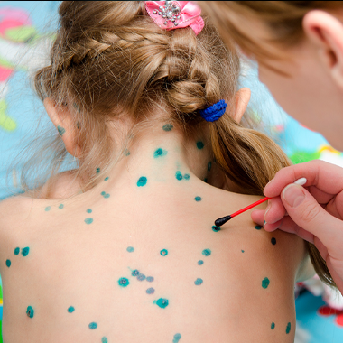 Ветряная оспа или ветрянка